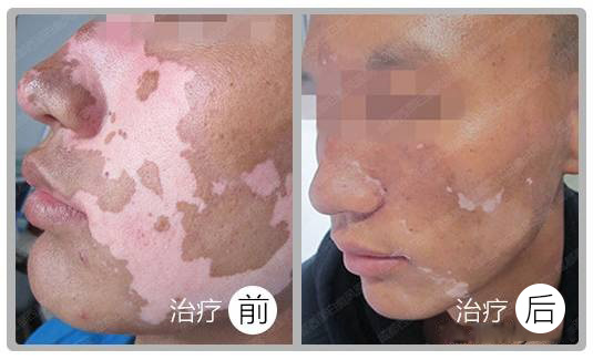 阜陽皮膚病醫(yī)院